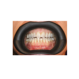 Vision Butler Medium Mouth Retractor