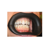 Vision Butler Medium Mouth Retractor