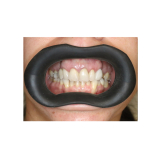 Vision Butler Medium Mouth Retractor