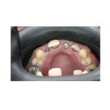 Vision Butler Medium Mouth Retractor