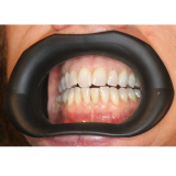 Vision Butler Large Mouth Retractor