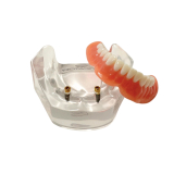 Locator Overdenture & Denture Model Set (2 Patient Models)