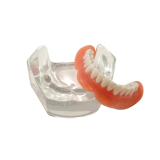 Locator Overdenture & Denture Model Set (2 Patient Models)