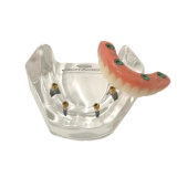 Locator Full Patient Model Kit (4 Patient Models)