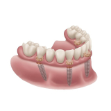 Locator Fixed Gold Starter Kit