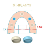 Locator Fixed Bronze Starter Kit