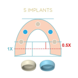 Locator Fixed Tan Anterior & Posterior Insert for 5+ 2pk